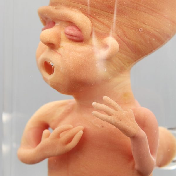 Jonny Carrcass Thalidomide Fetus in a Bottle
